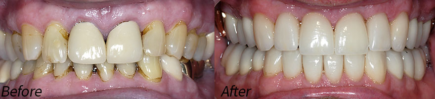 Before and After Photos at Vecchio Dental Care in Rockford, IL