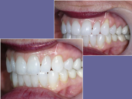 Before and After Photos at Vecchio Dental Care in Rockford, IL
