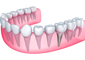 Benefits of Dental Implants in Rockford, IL