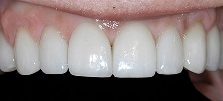 After Veneers at Vecchio Dental Care in Rockford, IL